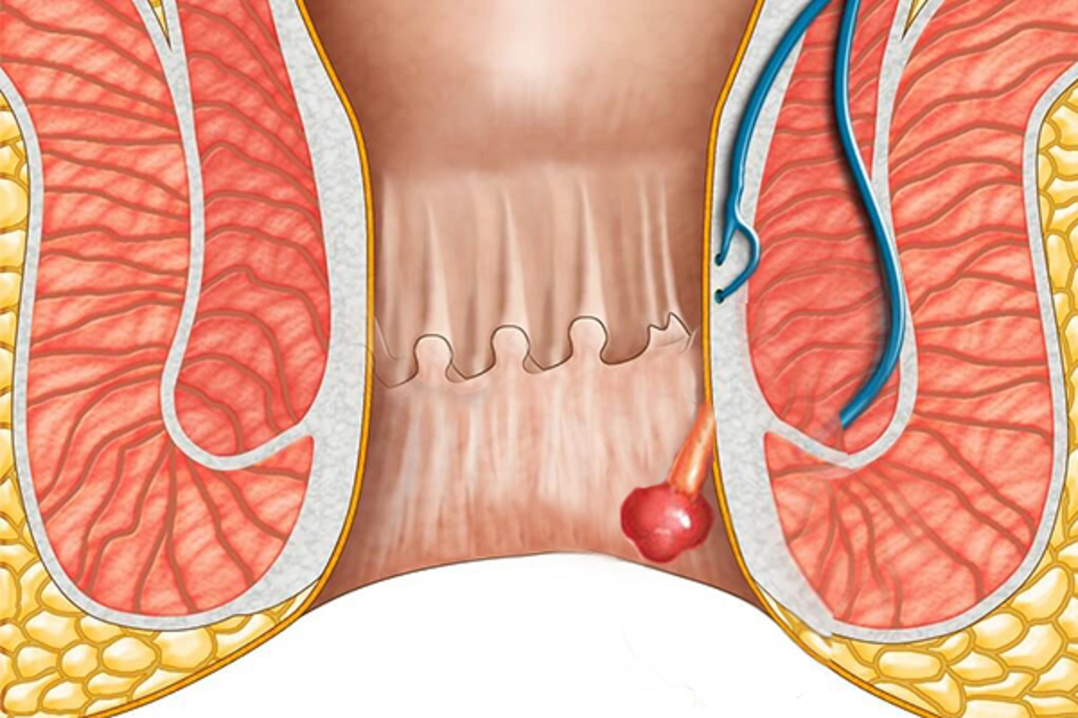 Наружный геморрой расположен непосредственно внутри ануса, чаще выпадает, в большей степени затрудняет опорожнение кишечника из-за значительной болезненности
