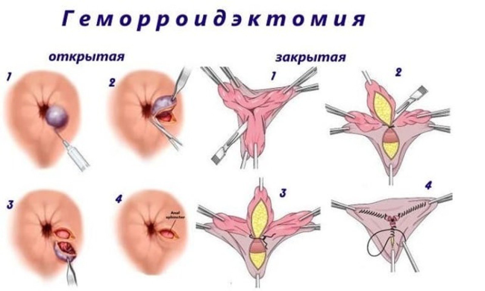Причиной развития тромбоза геморроидальных узлов считается гиподинамия, а именно - длительное сидение, в результате чего возникают застойные явления в сосудах малого таза