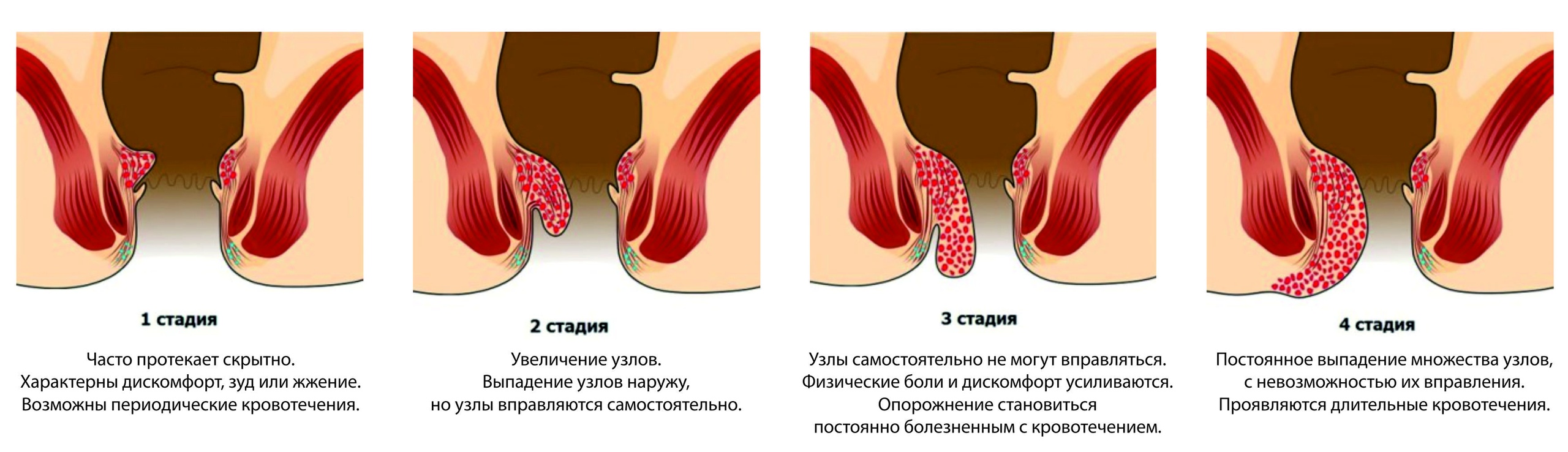 Запущенный, не леченый геморрой может вызвать анемию (снижение количества гемоглобина), заболевания опорно-двигательного аппарата