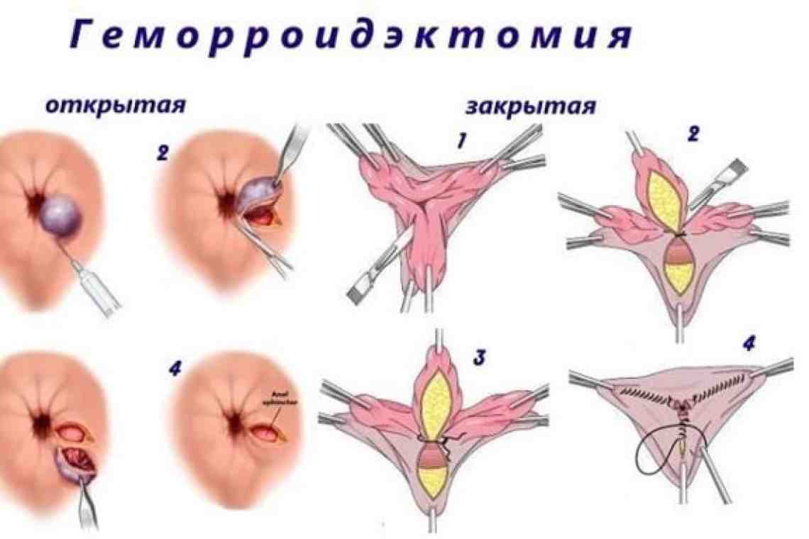 Ведущими симптомами тромбоза геморроидального узла являются интенсивные боли в промежности, а также дискомфорт в заднем проходе