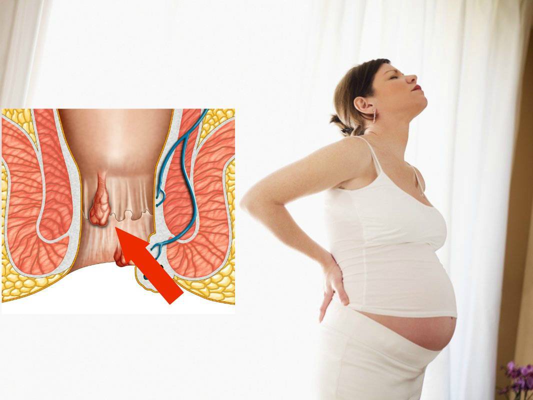 Геморрой при беременнорсти