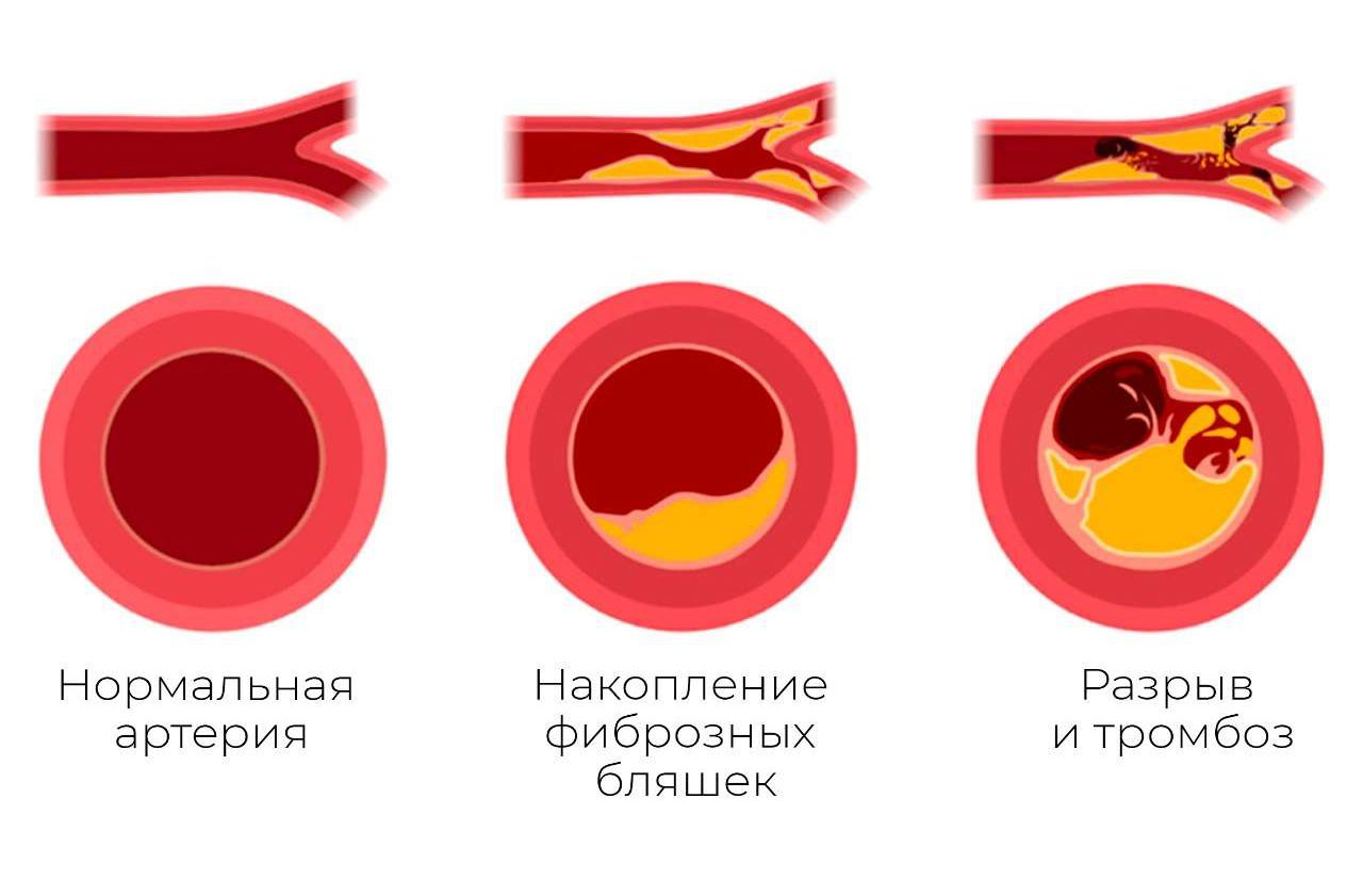 Под влиянием внешних факторов происходит сбой кровотока в зоне малого таза, сосуды и венозная стенка теряют эластичность и прочность