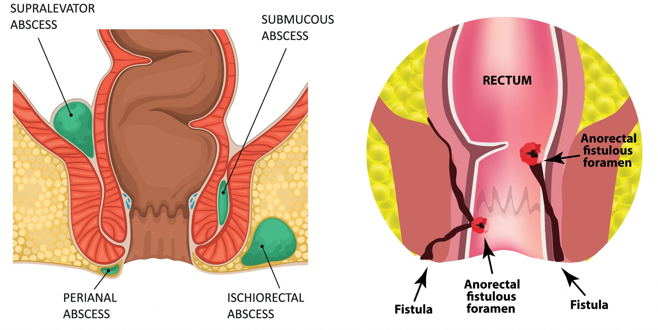 Болевой синдром при геморрое, отдающий в копчик, имеет постоянный тянущий характер, а также нарастает во время опорожнения кишечника